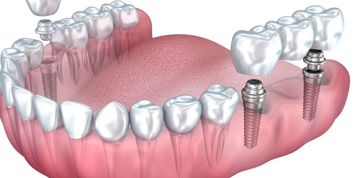 Why Dental Implants in Mumbai Are Gaining Popularity